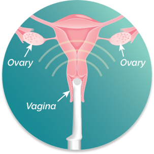 Illustration of uterus with ultrasound probe inserted. Anatomy labeled: vagina and ovaries.