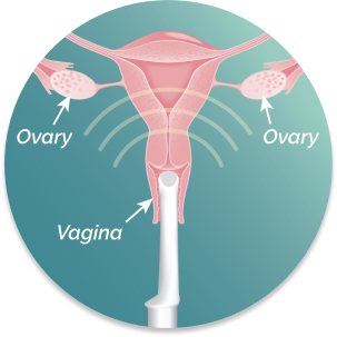 Illustration of uterus with ultrasound probe inserted. Anatomy labeled: vagina and ovaries.