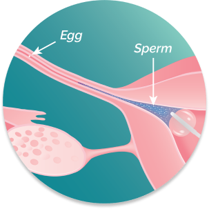 Illustration of uterus, zoomed to show fallopian tube and cornu. Sperm is delivered by FemaSeed and swims to meet the egg.