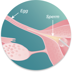 Illustration of uterus, zoomed to show fallopian tube and cornu. Sperm is delivered by FemaSeed and swims to meet the egg.