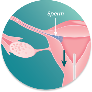 Illustration of uterus with sperm in fallopian tube, FemaSeed being removed.