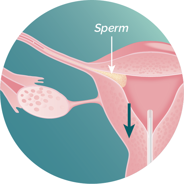 Illustration of uterus with sperm in fallopian tube, FemaSeed being removed.