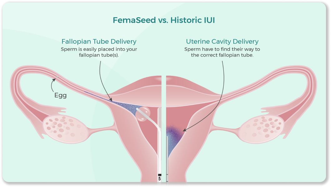 Femaseed vs. Historic IUI comparison graphic.