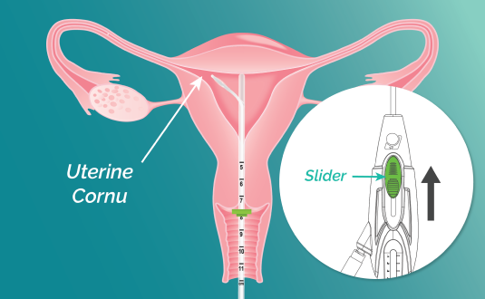 A vector illustration of cross section uterus with FemaSeed inserted, delivering washed sperm into the fallopian tube toward the dominant follicle. Inset image of device with plunger labeled.