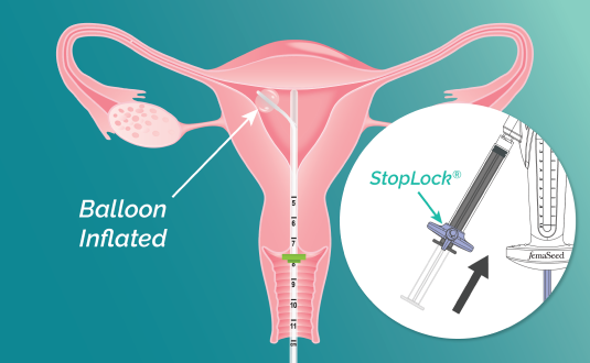 A vector illustration of cross section uterus with FemaSeed inserted, delivering washed sperm into the fallopian tube toward the dominant follicle. Inset image of device with plunger labeled.